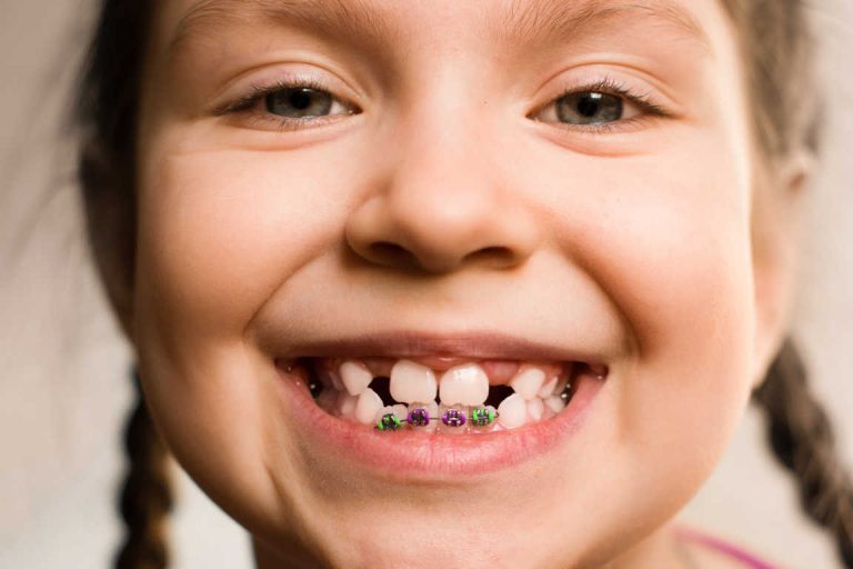 A qué edad hay que poner ortodoncia a los niños
