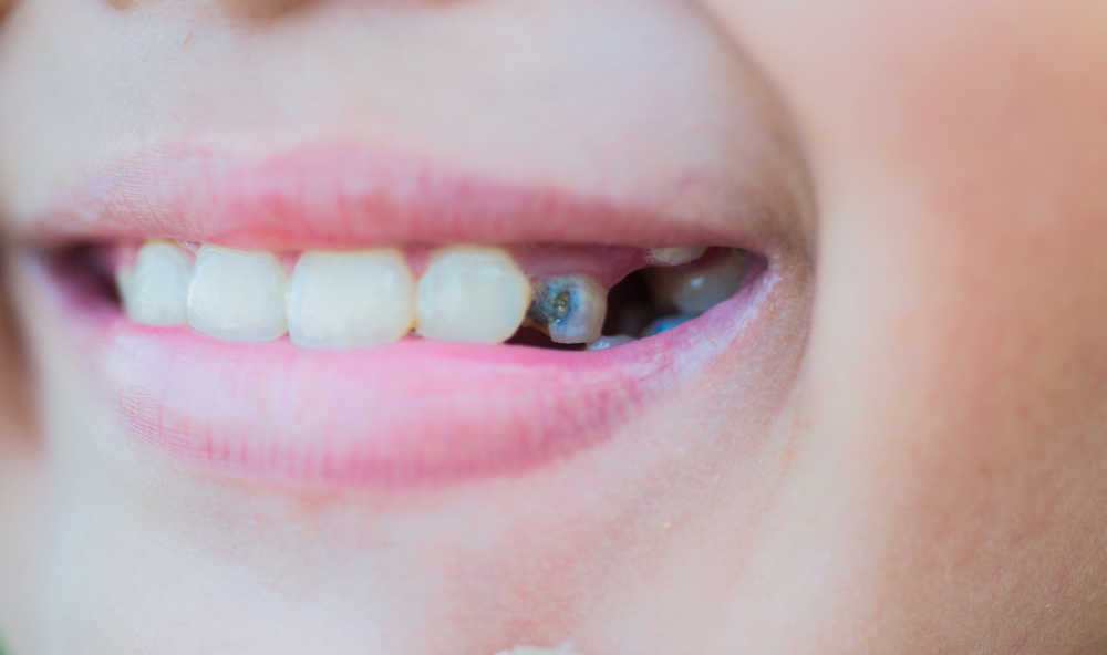 La erosión dental en los niños